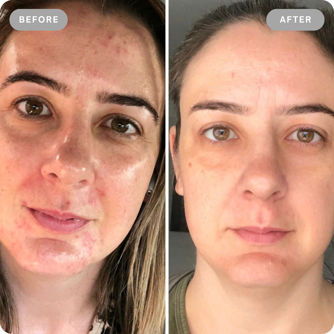 Dermalyt