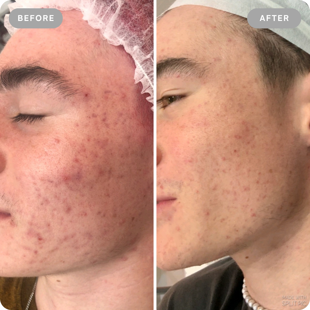 Dermalyt
