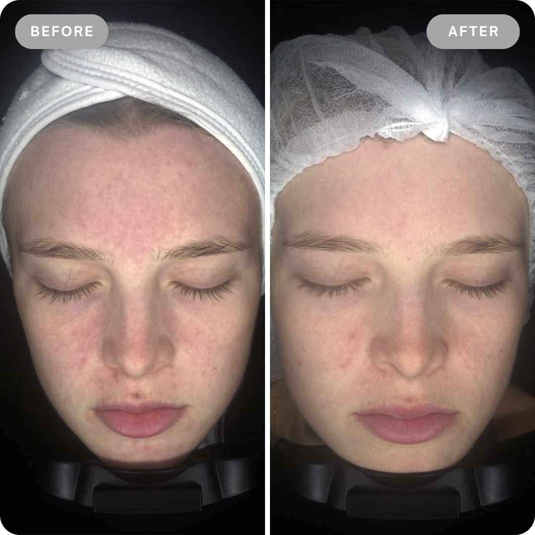Dermalyt